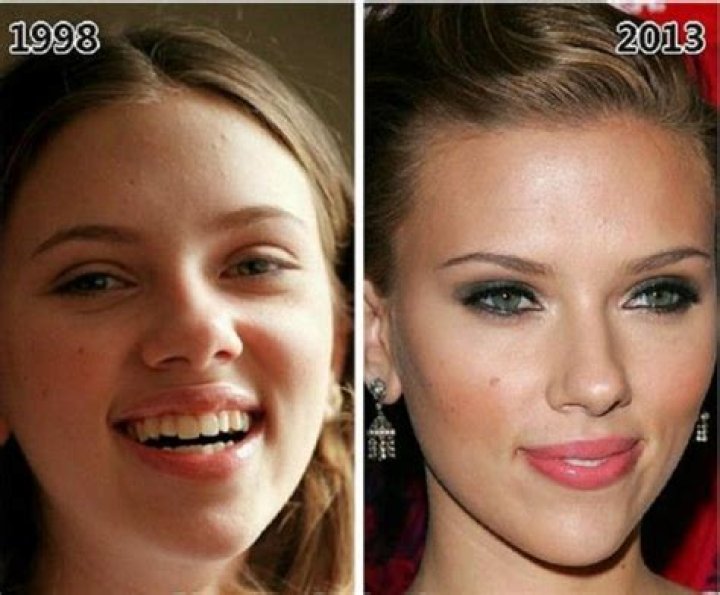 Unveiling Scarlett Johansson's Plastic Surgery Journey: Truth Or Speculation?